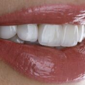qué son las carillas dentales