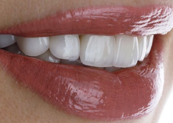 Tratamiento de carillas dentales: qué son y cuándo son recomendables