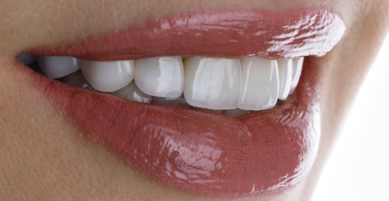 qué son las carillas dentales