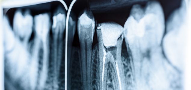 inflamación de conductos y tratamiento de endodoncia
