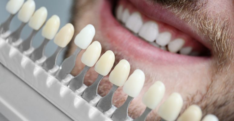 tipos de carillas dentales y beneficios
