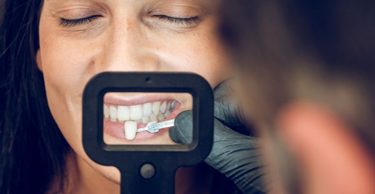 qué es el tratamiento de carillas dentales