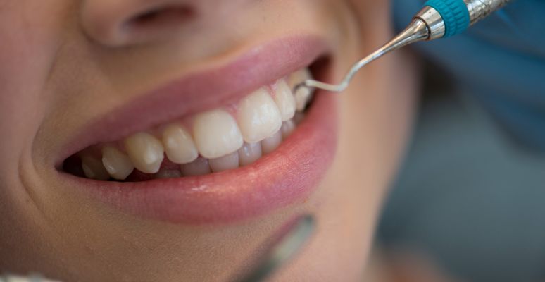 consejos de limpieza para prevenir las caries