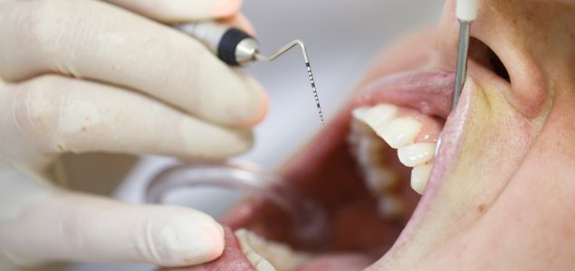 tratamiento de periodoncia con limpieza profesional
