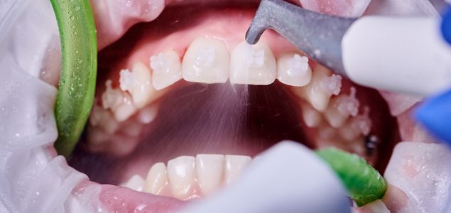 limpieza dental con airflow