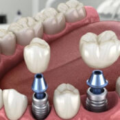 colocación de implantes dentales