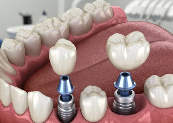 ¿Es dolorosa la colocación de implantes dentales?
