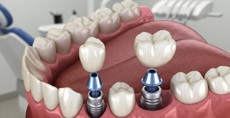 colocación de implantes dentales