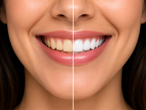 Blanqueamiento dental profesional: Por qué marca la diferencia en tu sonrisa.