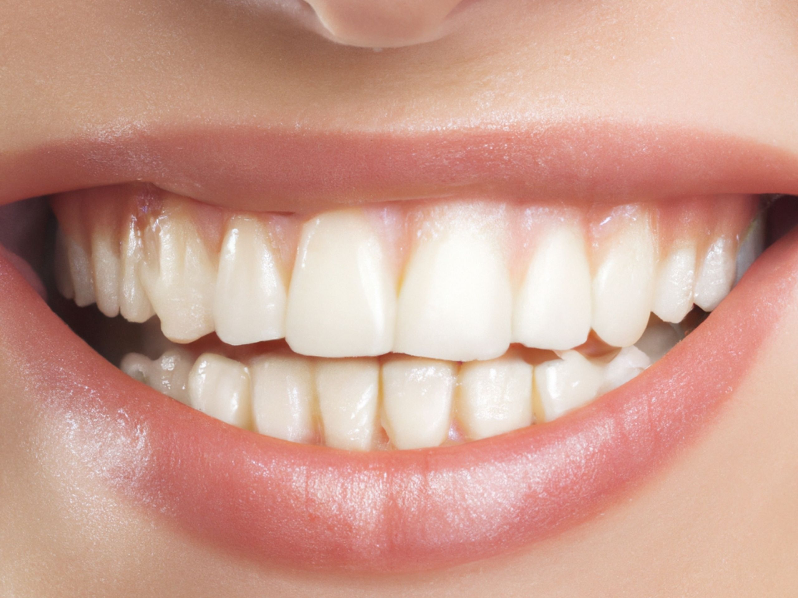 Blanqueamiento dental - Clínica Dental Ramón Abril Granada