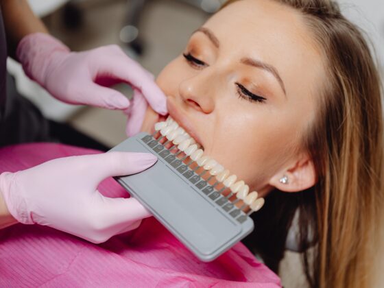Carillas dentales: Tipos, para qué sirven y cómo transforman tu sonrisa.