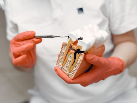 Endodoncia: Qué es, cuándo se necesita y cómo es el proceso.