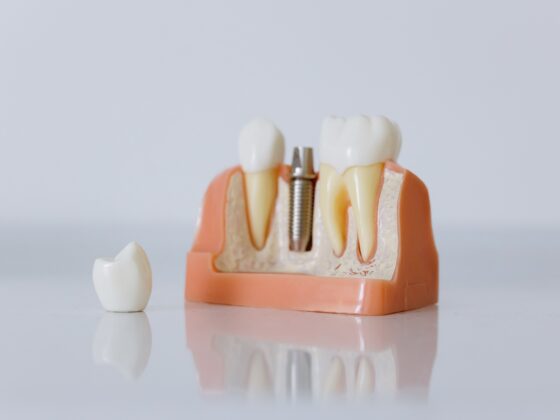 ¿Cuánto dura un implante dental? Todo lo que debes saber antes de ponértelo.